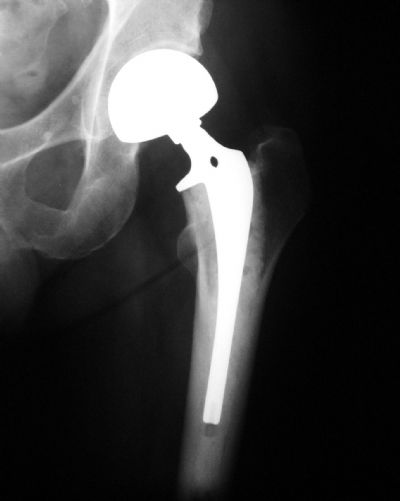 J & J Modular Hemiarthroplasty (Implant 240)